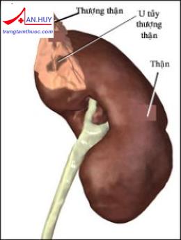 U tủy thượng thận - Hình ảnh minh họa